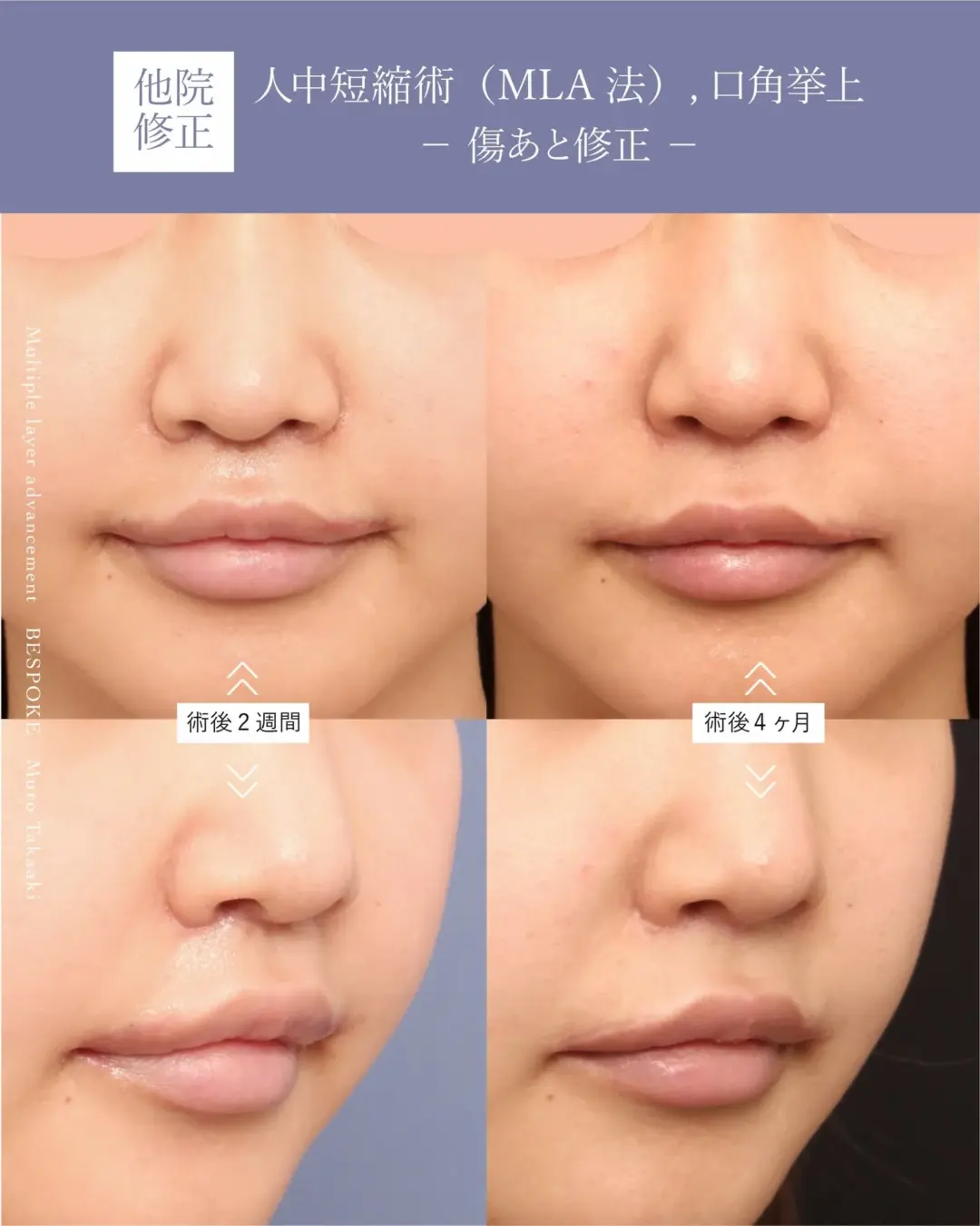 傷あと人中04 (2) 上口唇短縮術(人中短縮術)の症例