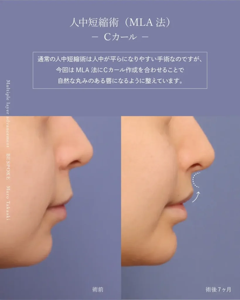 人中短縮術（上口唇短縮術）の症例