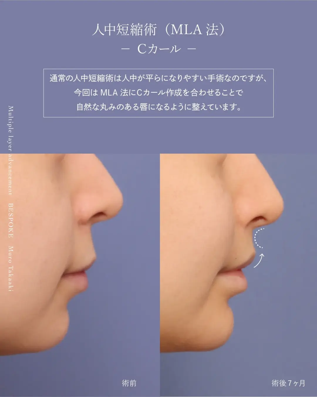 人中短縮術（上口唇短縮術）の症例