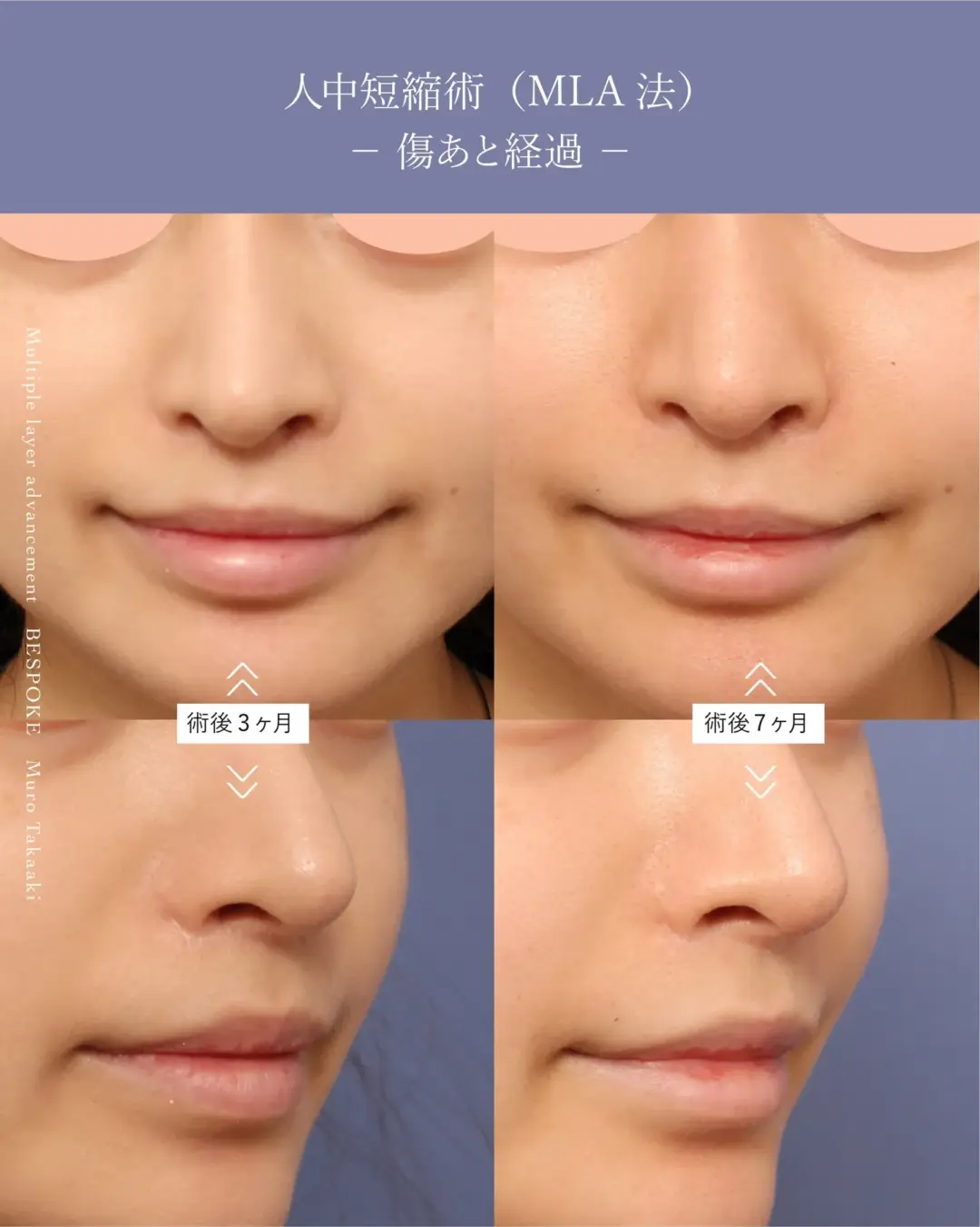 人中短縮術（上口唇短縮術）の症例