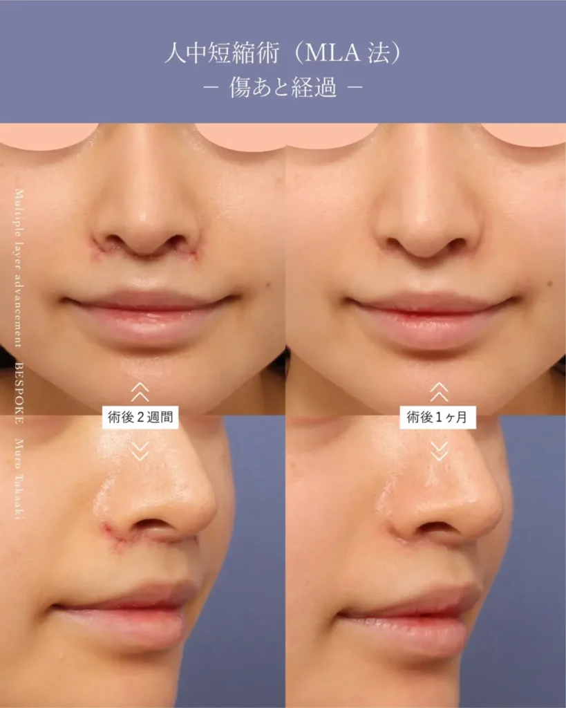 人中短縮術（上口唇短縮術）の症例