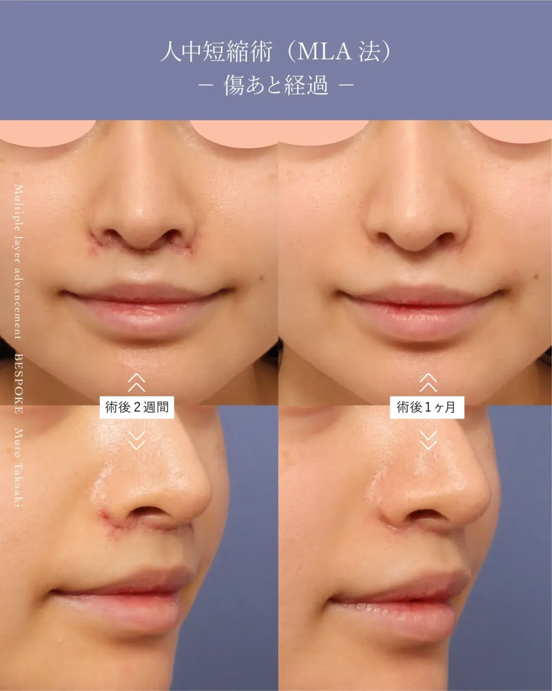 人中短縮術（上口唇短縮術）の症例