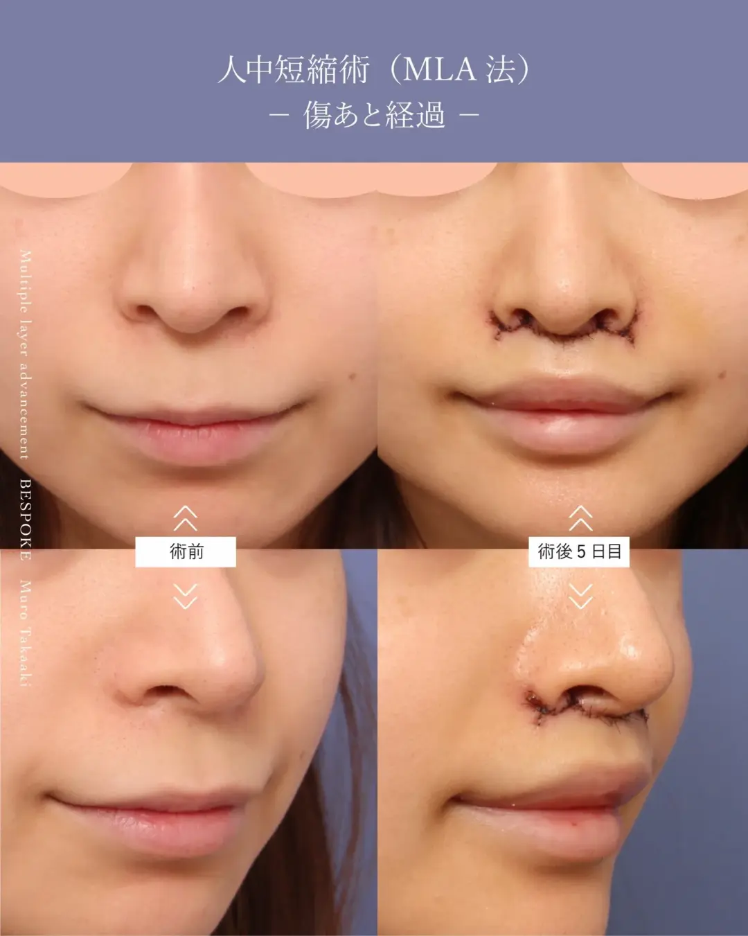 【上口唇短縮術（人中短縮術）】歯があまり見えない口元をMLA法で人中を短くCカールも叶える