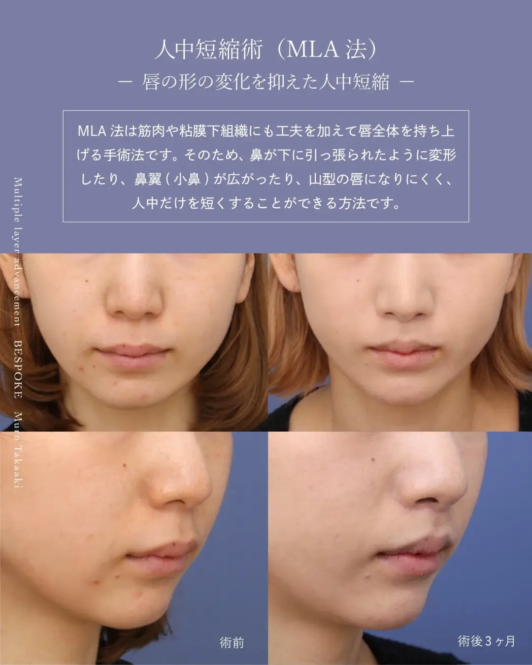 上口唇短縮術（人中短縮術）の症例