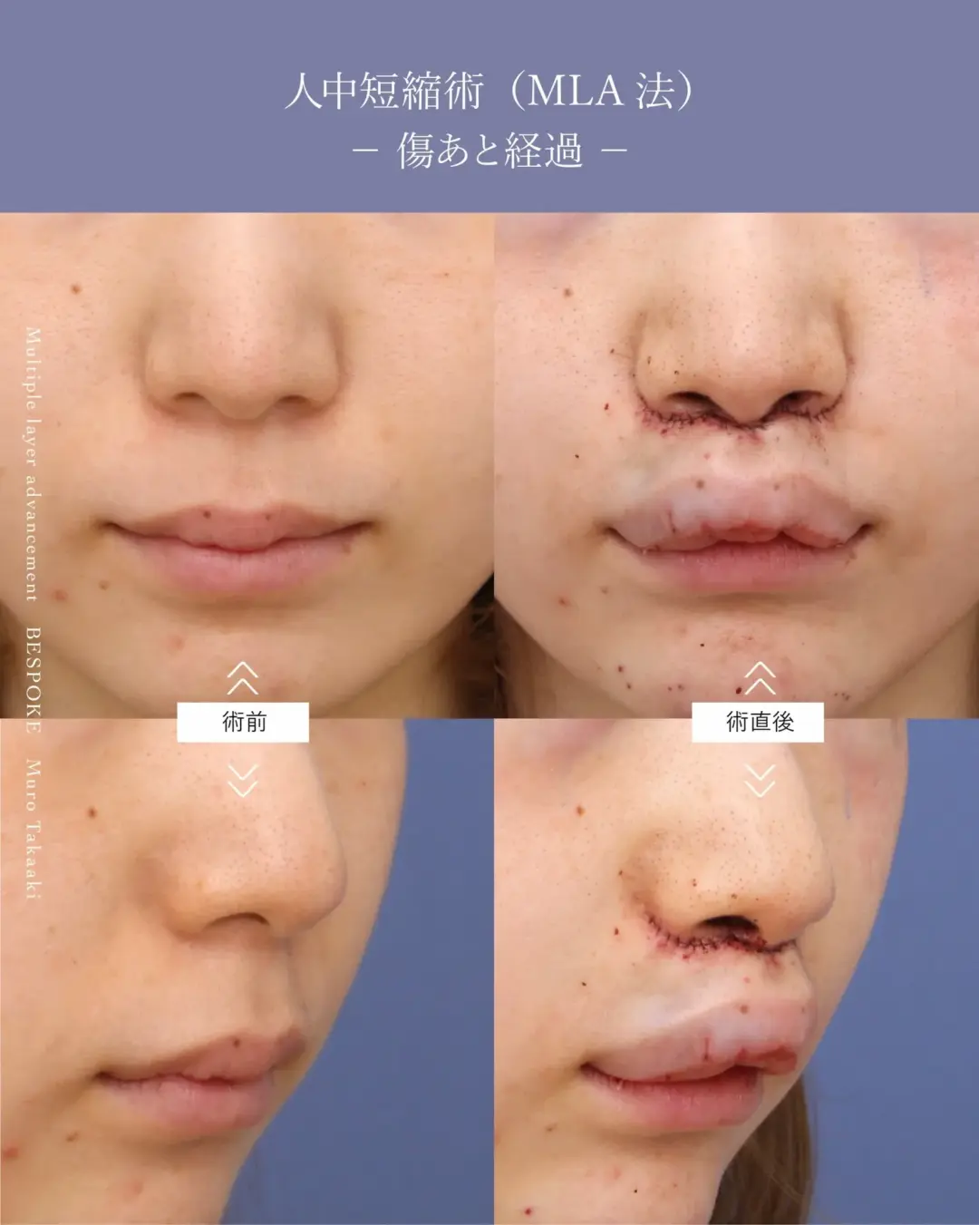 【上口唇短縮術（人中短縮術）】唇の形をなるべく変えずに鼻の下（人中）を短く改善