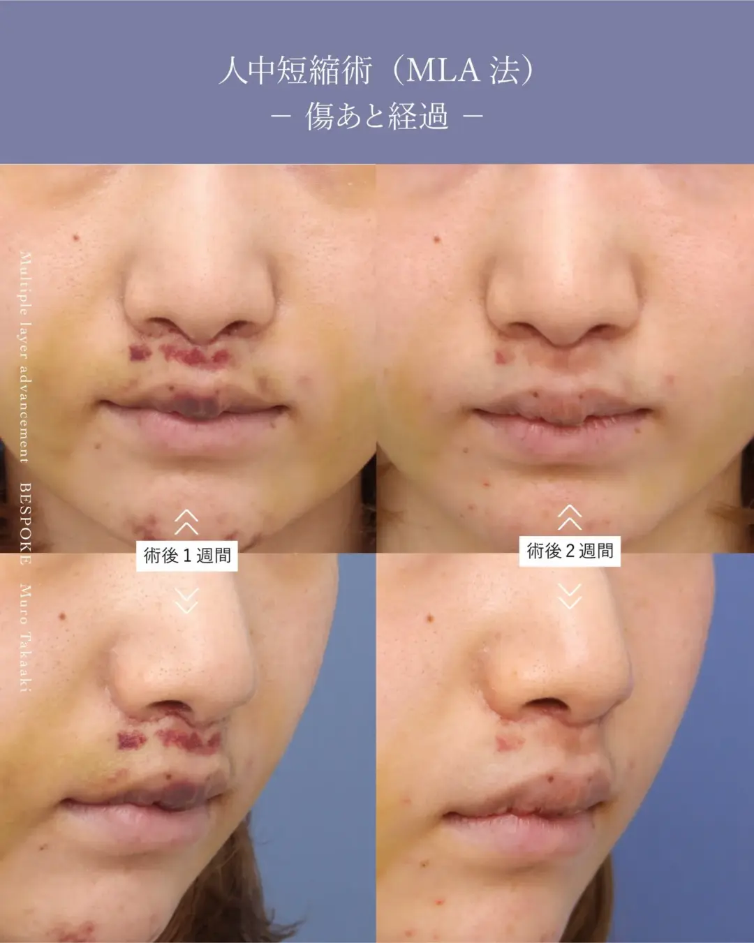 上口唇短縮術（人中短縮術）の症例