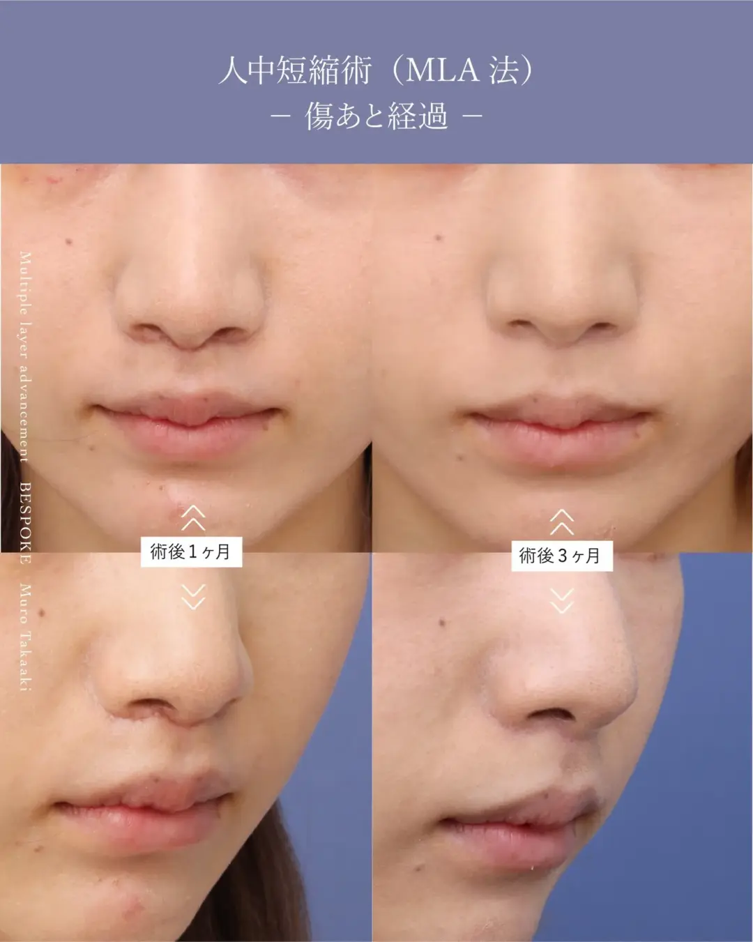 上口唇短縮術（人中短縮術）の症例