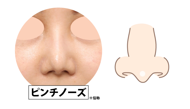 ピンチノーズ