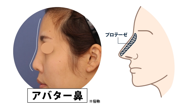 アバター鼻