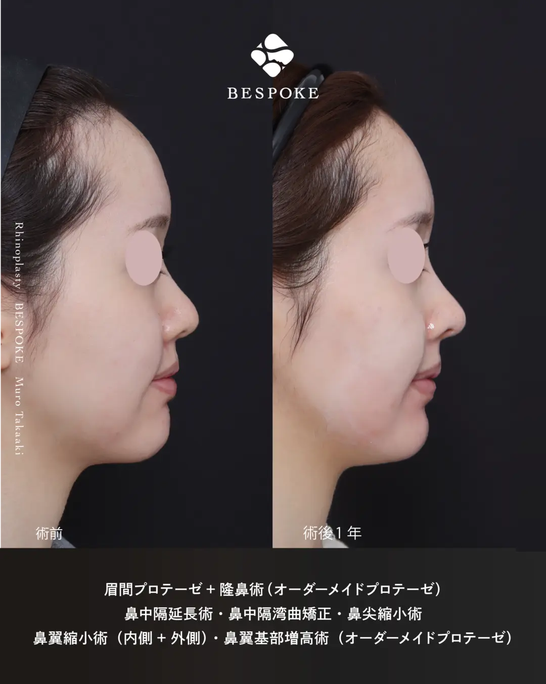 眉間プロテーゼ挿入術、隆鼻術、鼻中隔延長術、鼻尖縮小術、鼻翼縮小術の症例