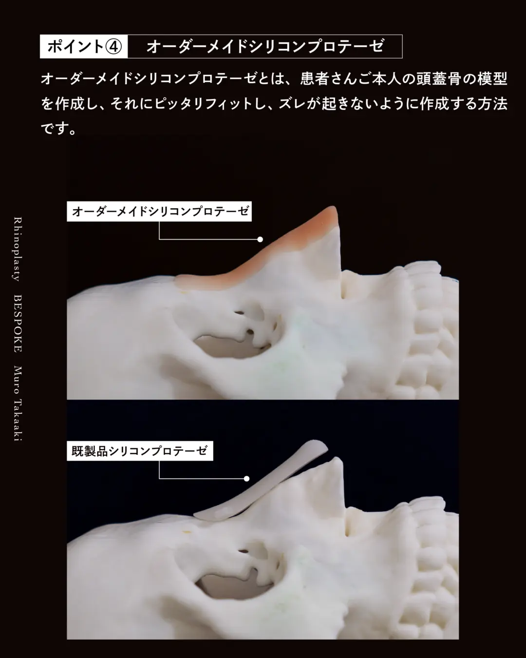 眉間プロテーゼ挿入術、隆鼻術、鼻中隔延長術、鼻尖縮小術、鼻翼縮小術の症例