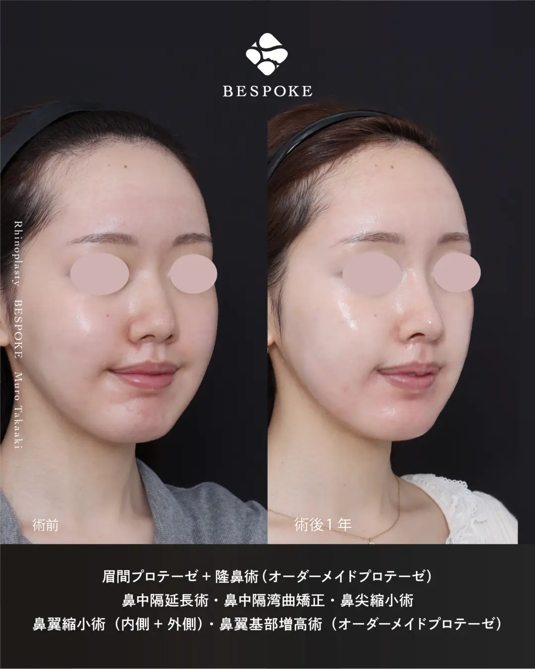 【鼻整形】鼻が短く広がった小鼻をオーダープロテーゼや鼻翼縮小（小鼻縮小）術などで改善して立体感を出す