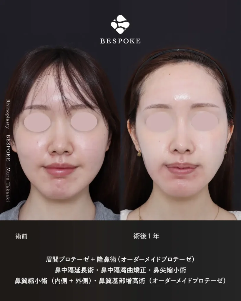 眉間プロテーゼ挿入術、隆鼻術、鼻中隔延長術、鼻尖縮小術、鼻翼縮小術の症例