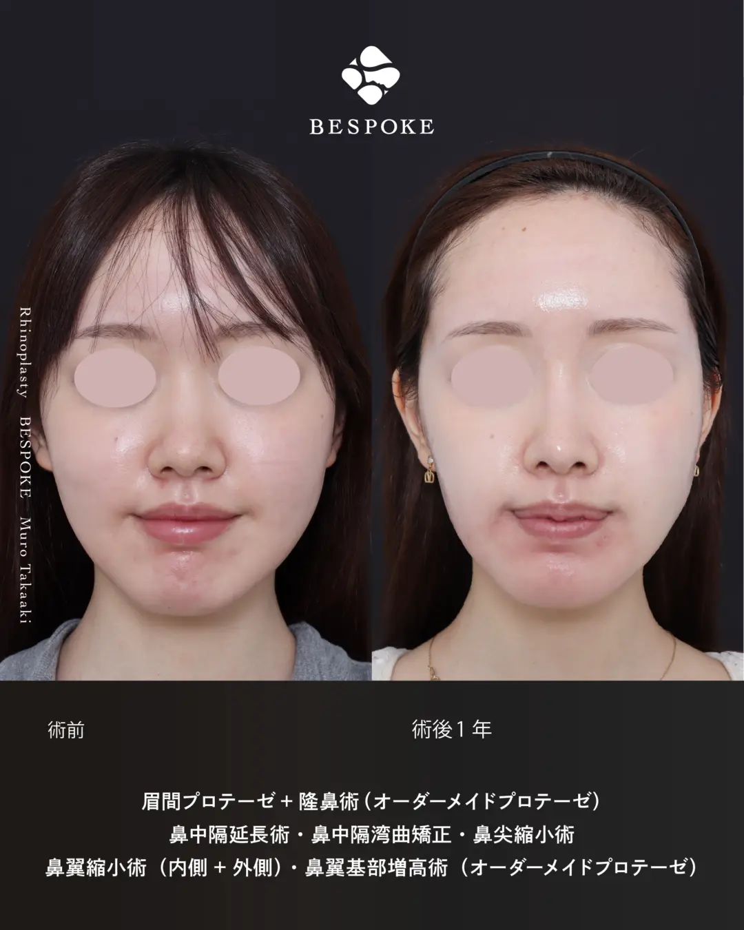 眉間プロテーゼ挿入術、隆鼻術、鼻中隔延長術、鼻尖縮小術、鼻翼縮小術の症例