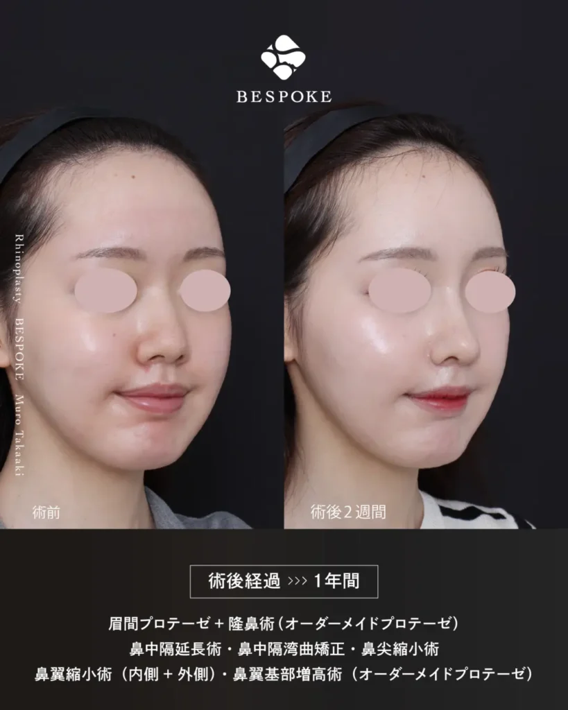 眉間プロテーゼ挿入術、隆鼻術、鼻中隔延長術、鼻尖縮小術、鼻翼縮小術の症例