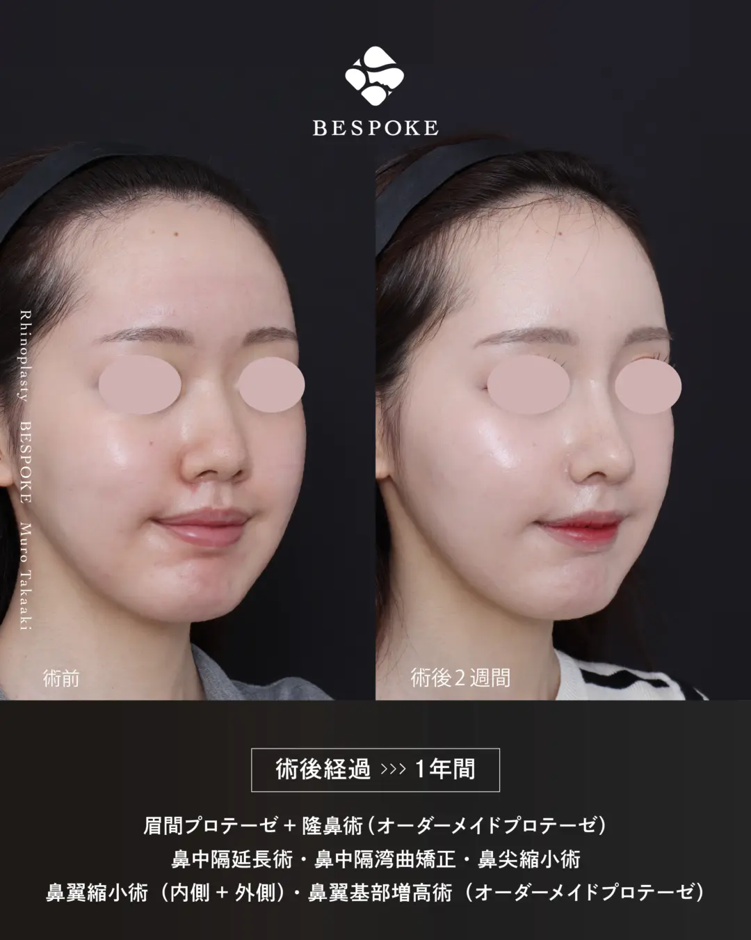 眉間プロテーゼ挿入術、隆鼻術、鼻中隔延長術、鼻尖縮小術、鼻翼縮小術の症例