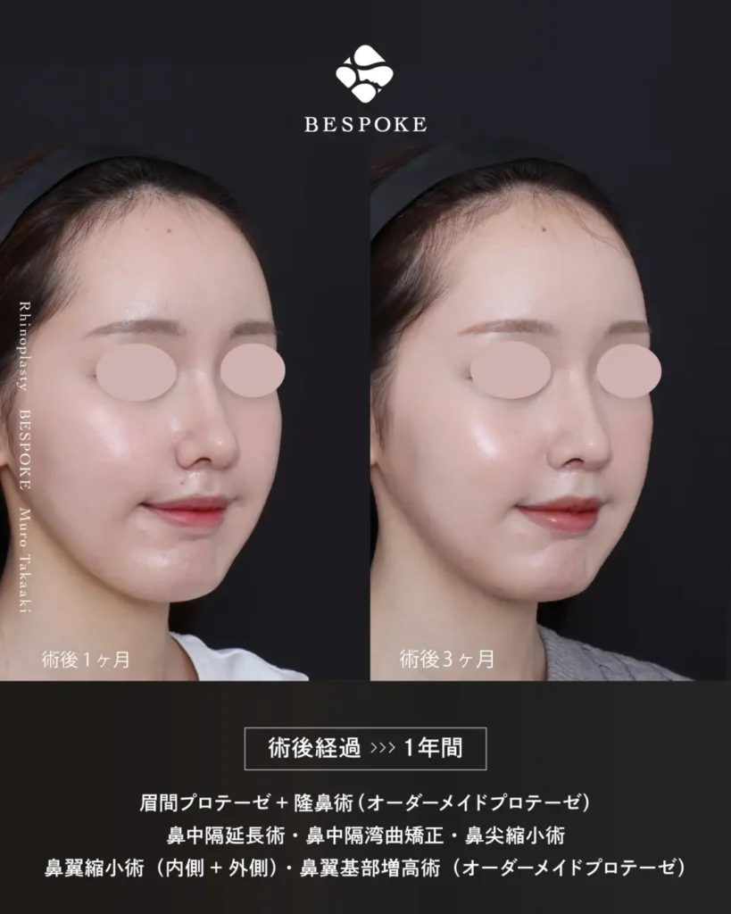 眉間プロテーゼ挿入術、隆鼻術、鼻中隔延長術、鼻尖縮小術、鼻翼縮小術の症例