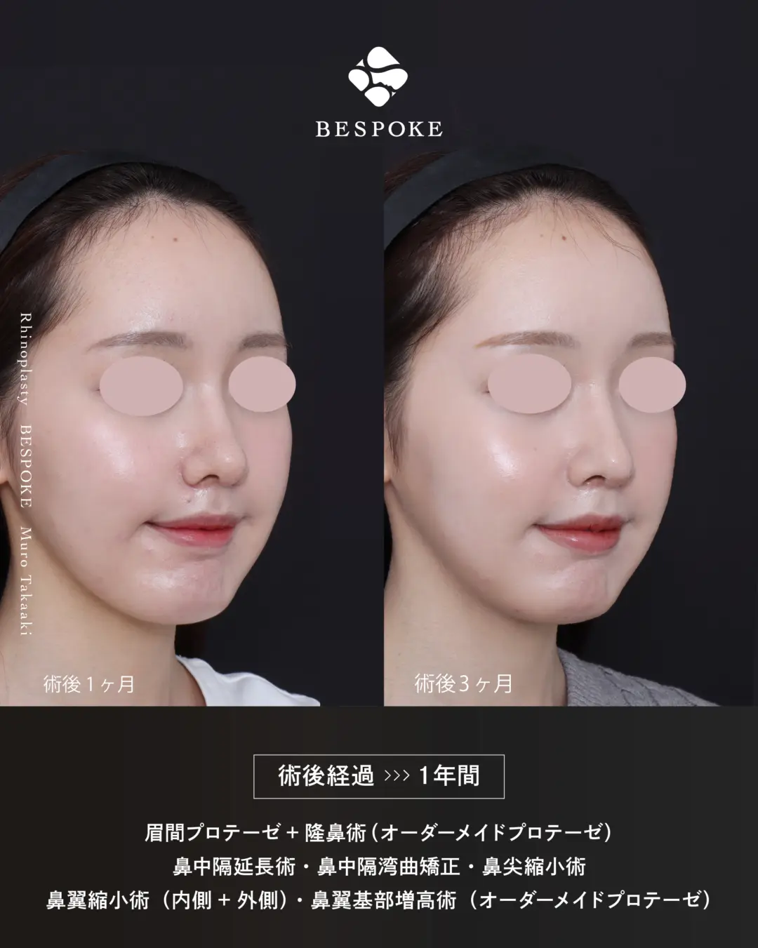 眉間プロテーゼ挿入術、隆鼻術、鼻中隔延長術、鼻尖縮小術、鼻翼縮小術の症例