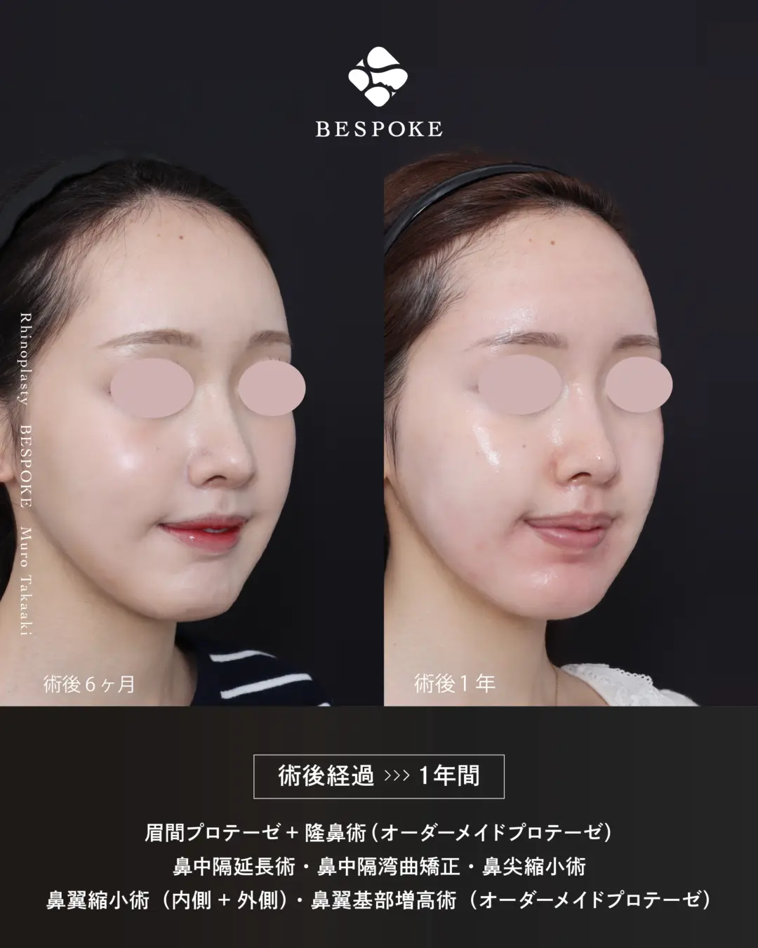 眉間プロテーゼ挿入術、隆鼻術、鼻中隔延長術、鼻尖縮小術、鼻翼縮小術の症例