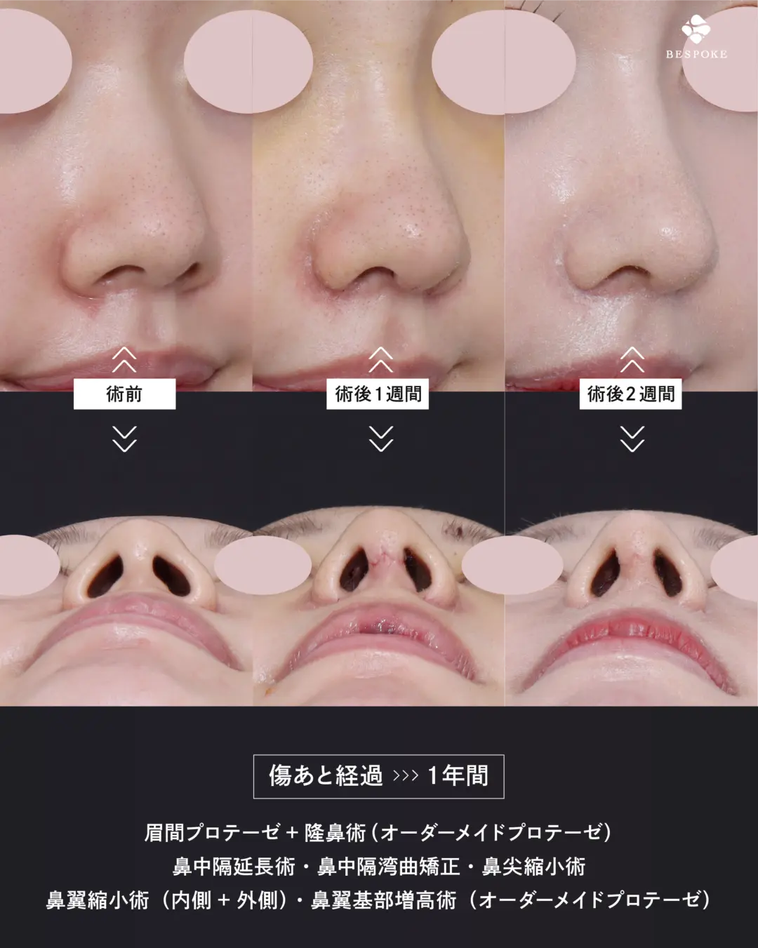 眉間プロテーゼ挿入術、隆鼻術、鼻中隔延長術、鼻尖縮小術、鼻翼縮小術の症例