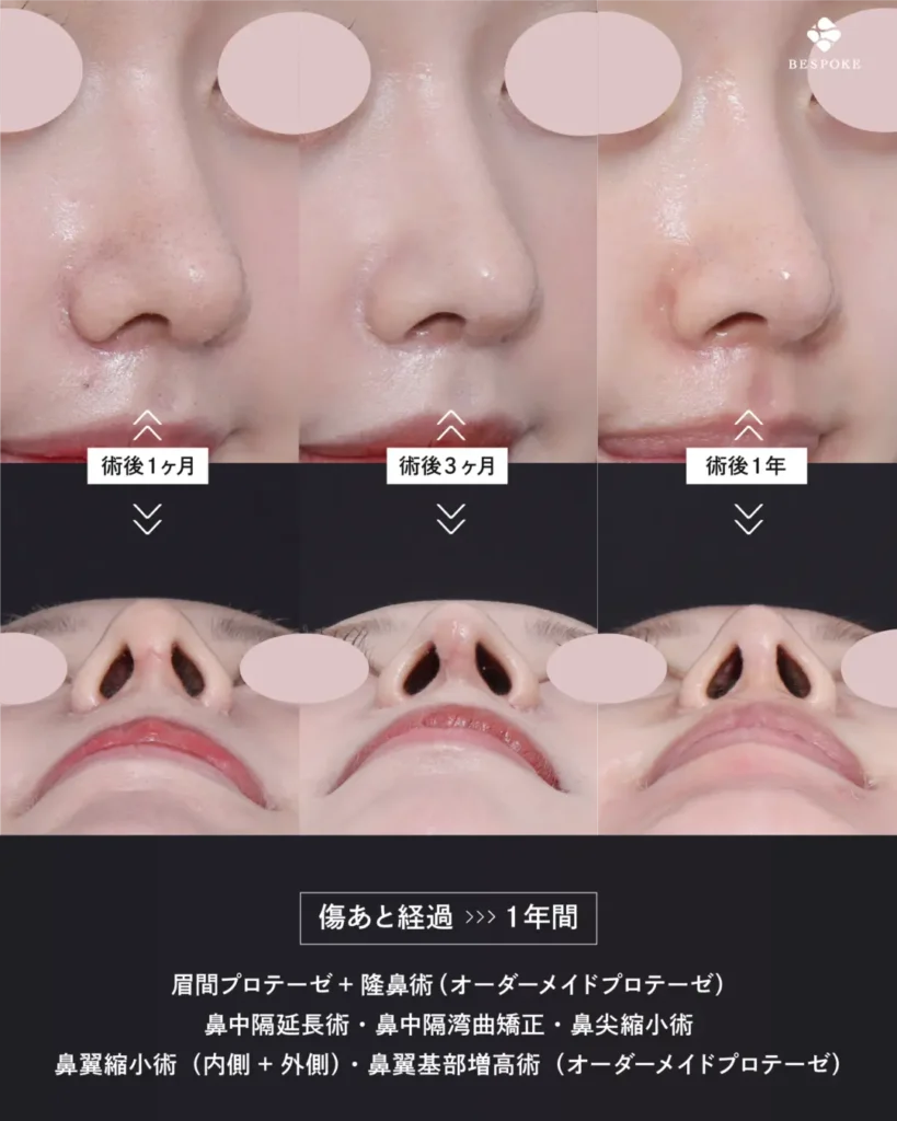 眉間プロテーゼ挿入術、隆鼻術、鼻中隔延長術、鼻尖縮小術、鼻翼縮小術の症例