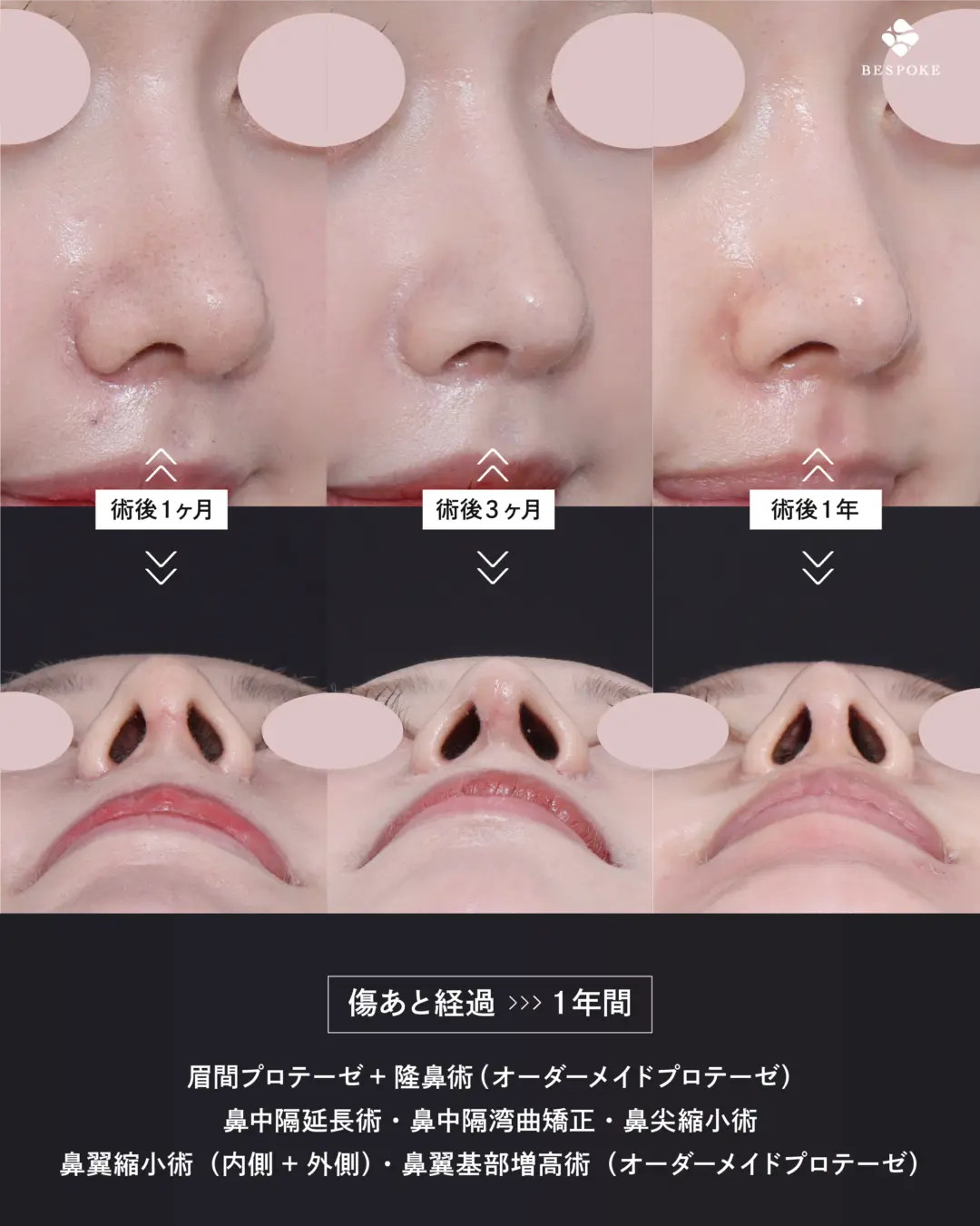 眉間プロテーゼ挿入術、隆鼻術、鼻中隔延長術、鼻尖縮小術、鼻翼縮小術の症例