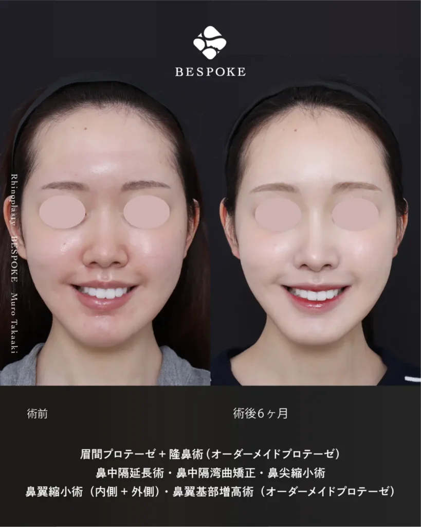 眉間プロテーゼ挿入術、隆鼻術、鼻中隔延長術、鼻尖縮小術、鼻翼縮小術の症例