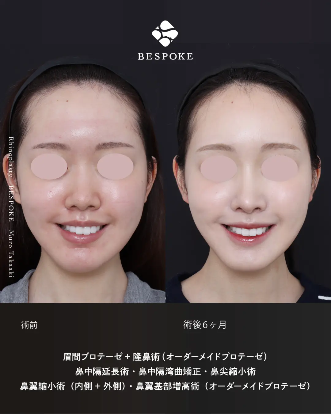 眉間プロテーゼ挿入術、隆鼻術、鼻中隔延長術、鼻尖縮小術、鼻翼縮小術の症例