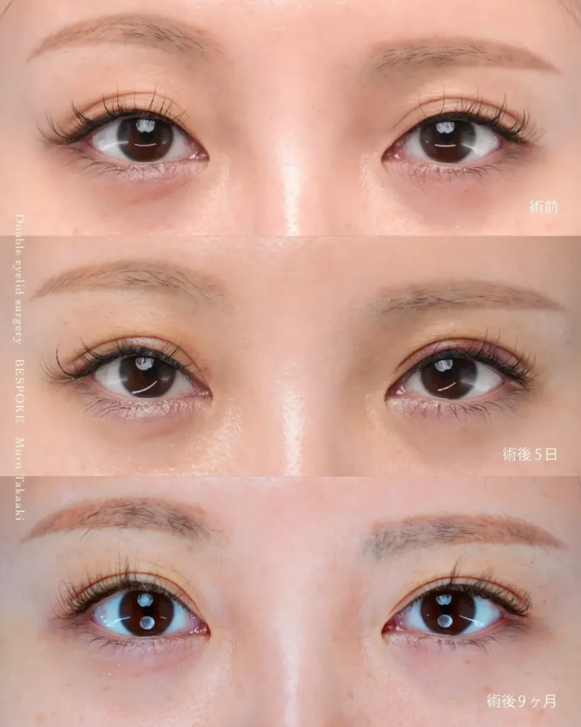 鍵穴式眼瞼下垂の症例