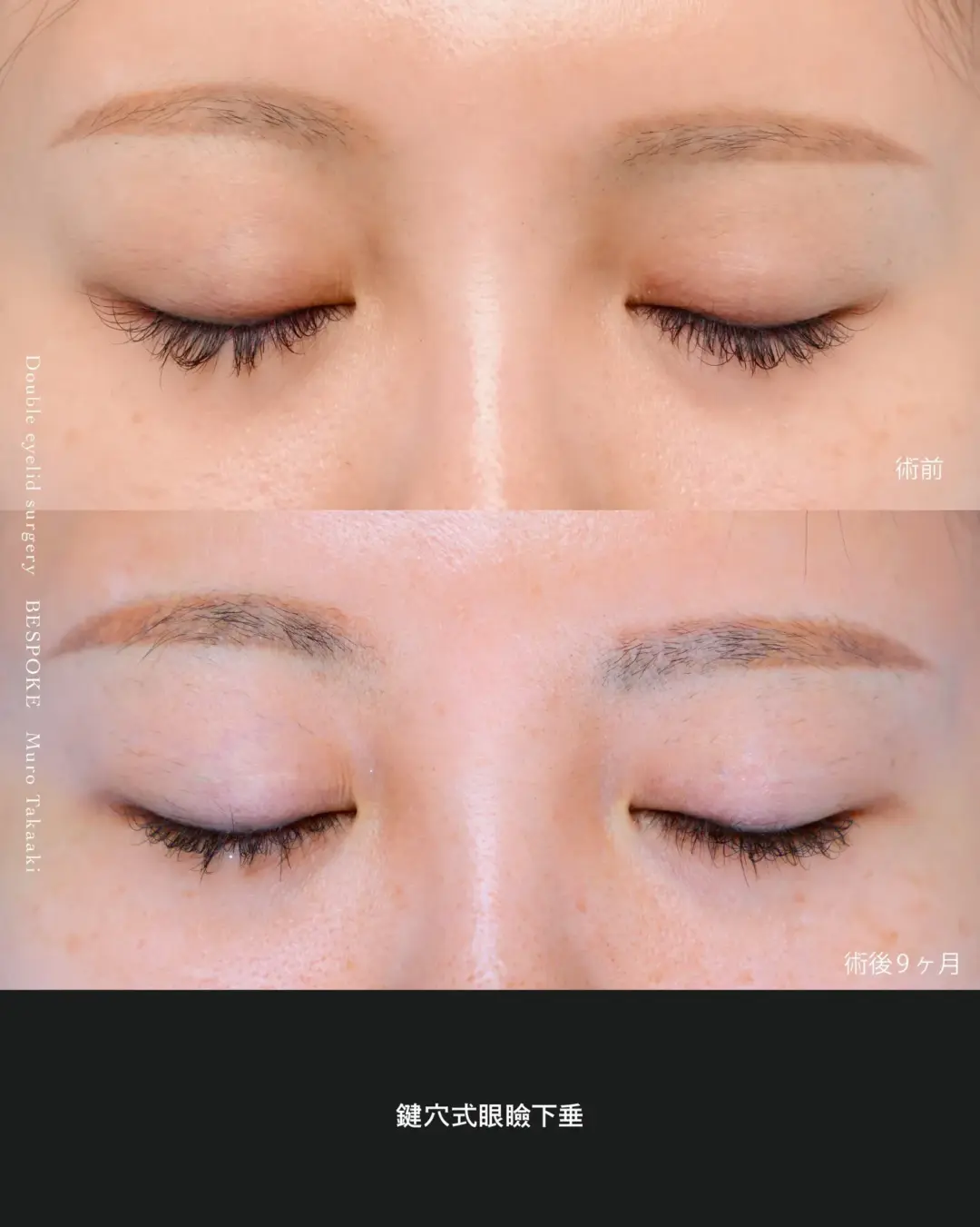 鍵穴式眼瞼下垂の症例