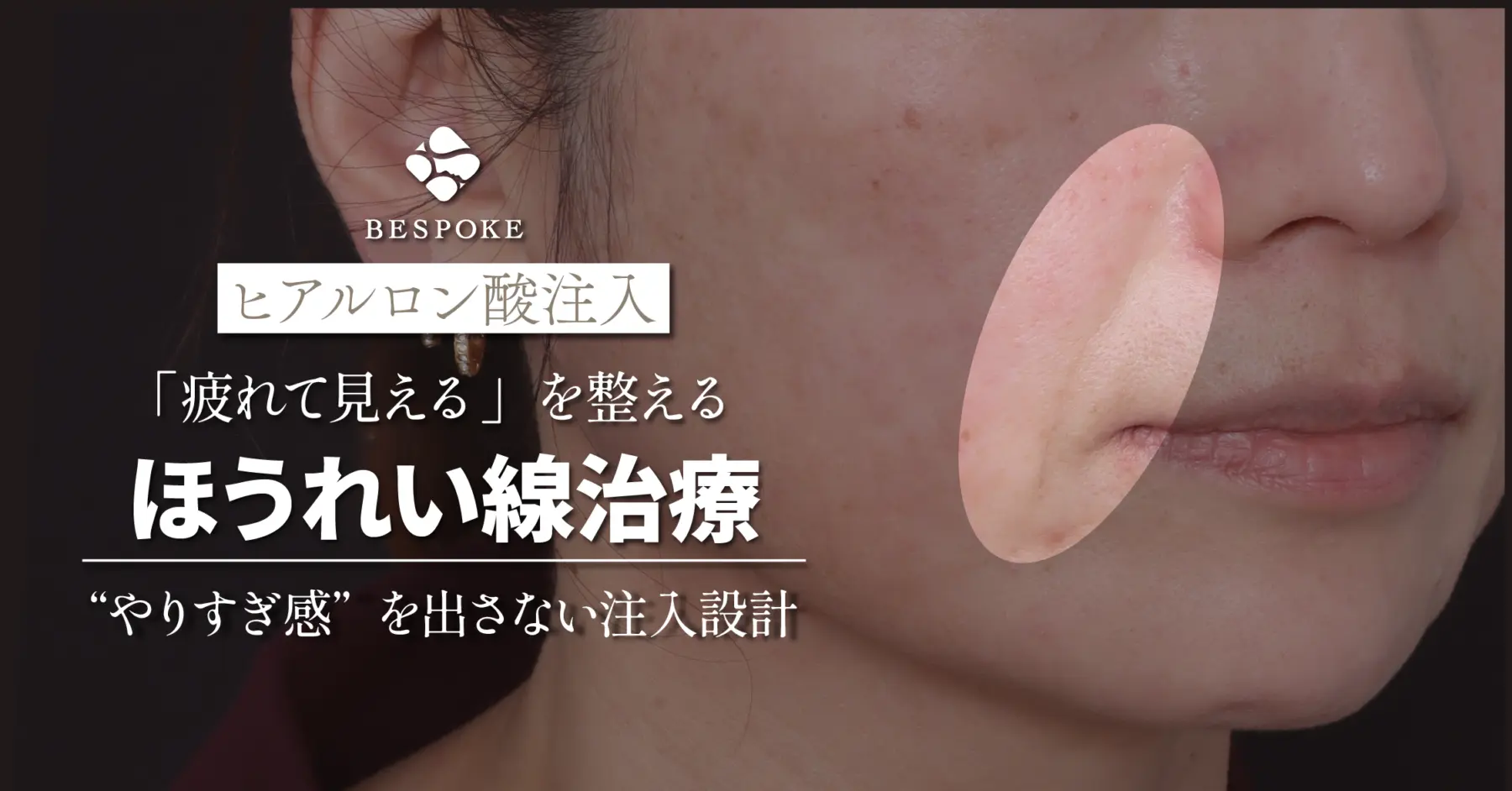 ヒアルロン酸でほうれい線対策