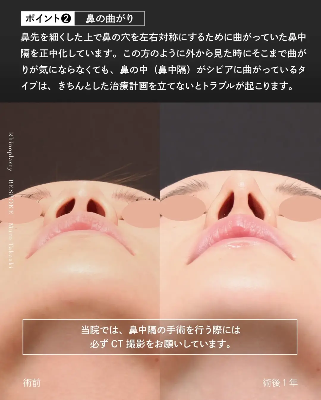 鼻中隔の曲がりイメージ