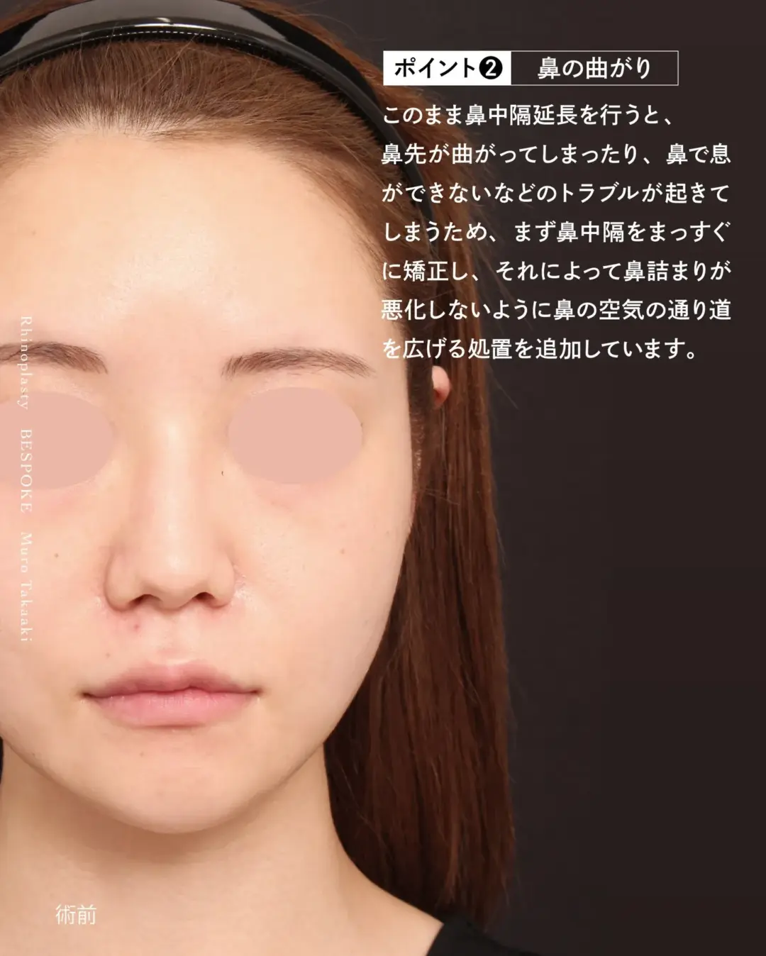 鼻中隔の曲がりイメージ