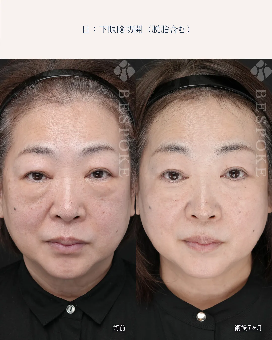 下眼瞼切開、下眼瞼脱脂の症例