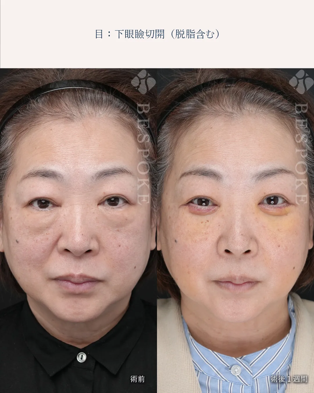 下眼瞼切開、下眼瞼脱脂の症例