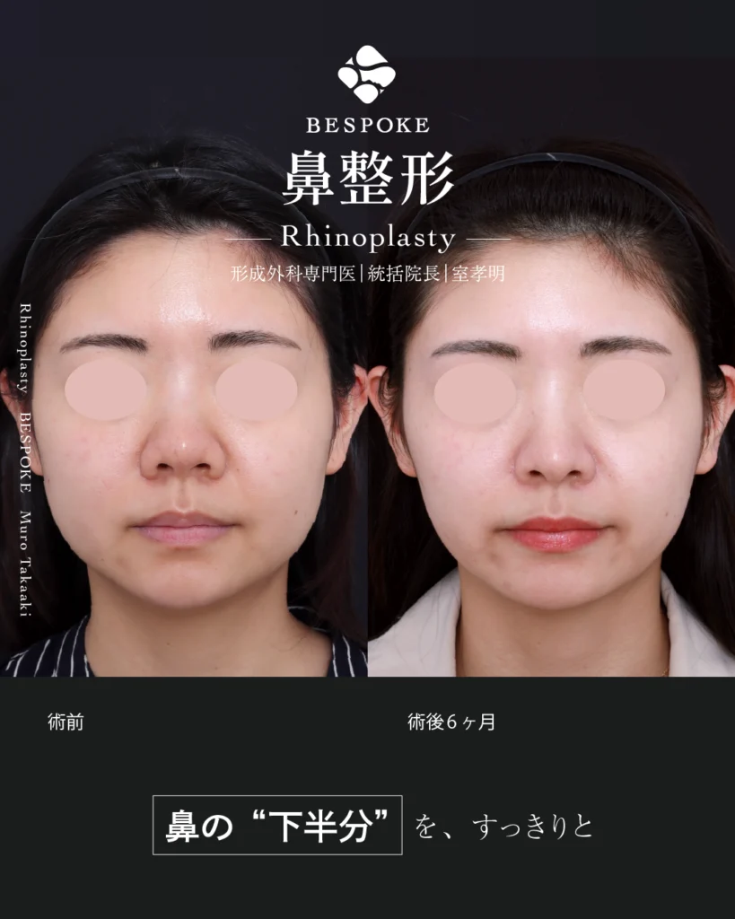 鼻中隔延長術、鼻尖縮小術、小鼻縮小術、鼻翼挙上術の症例