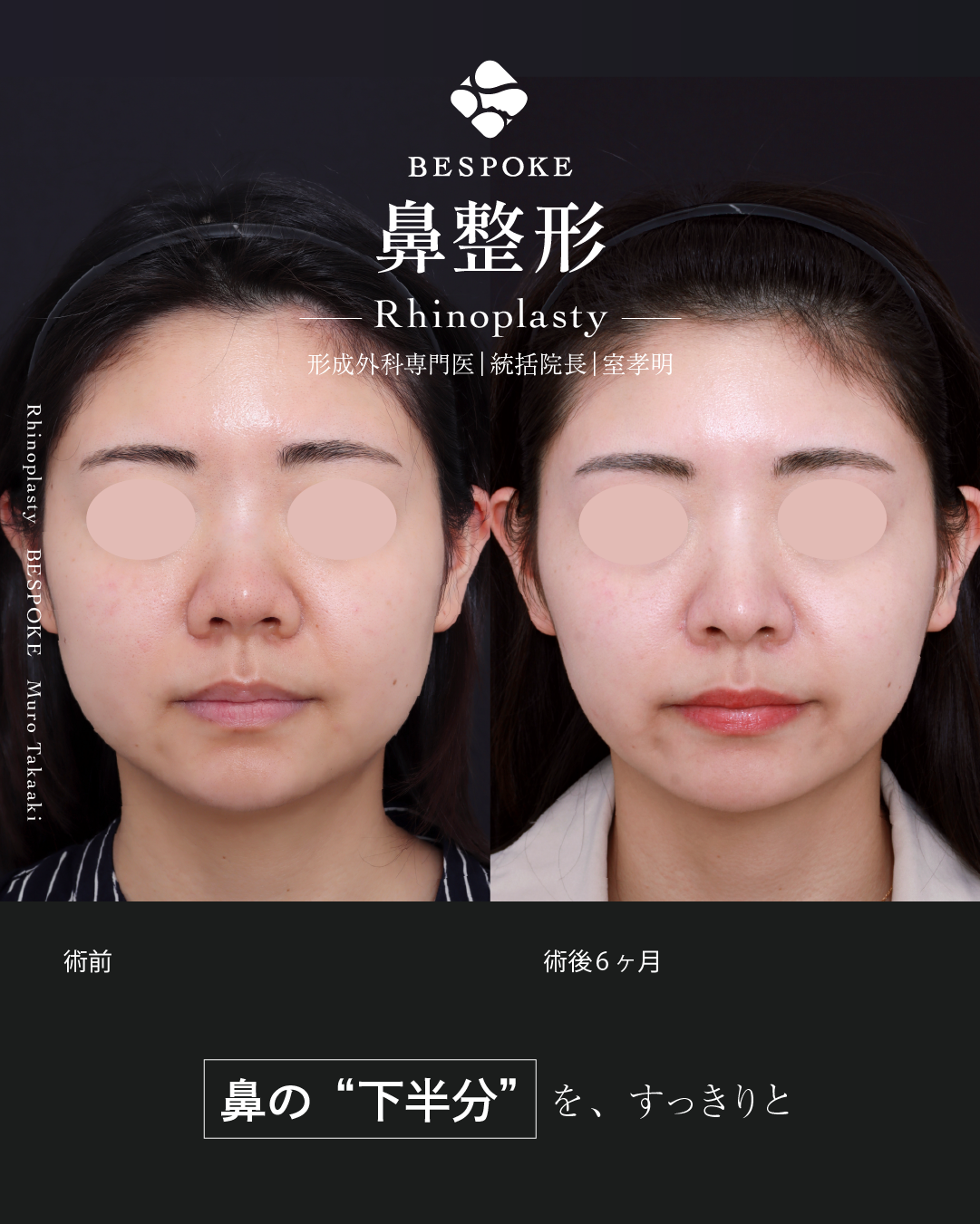 鼻中隔延長術、鼻尖縮小術、小鼻縮小術、鼻翼挙上術の症例