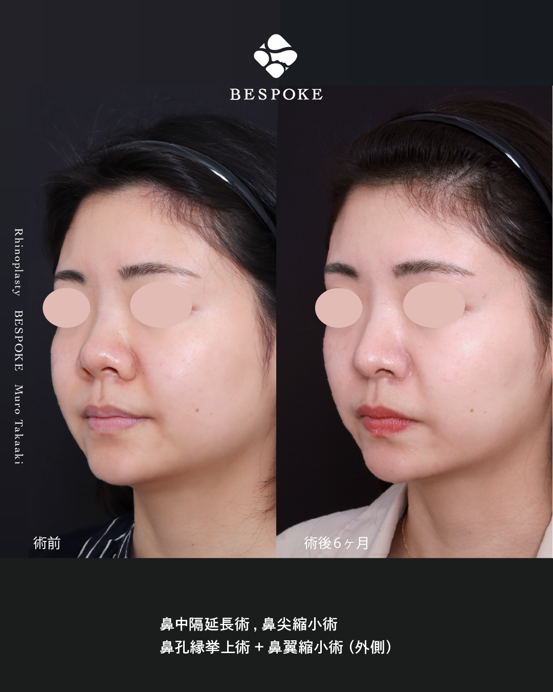 鼻中隔延長術、鼻尖縮小術、小鼻縮小術、鼻翼挙上術の症例