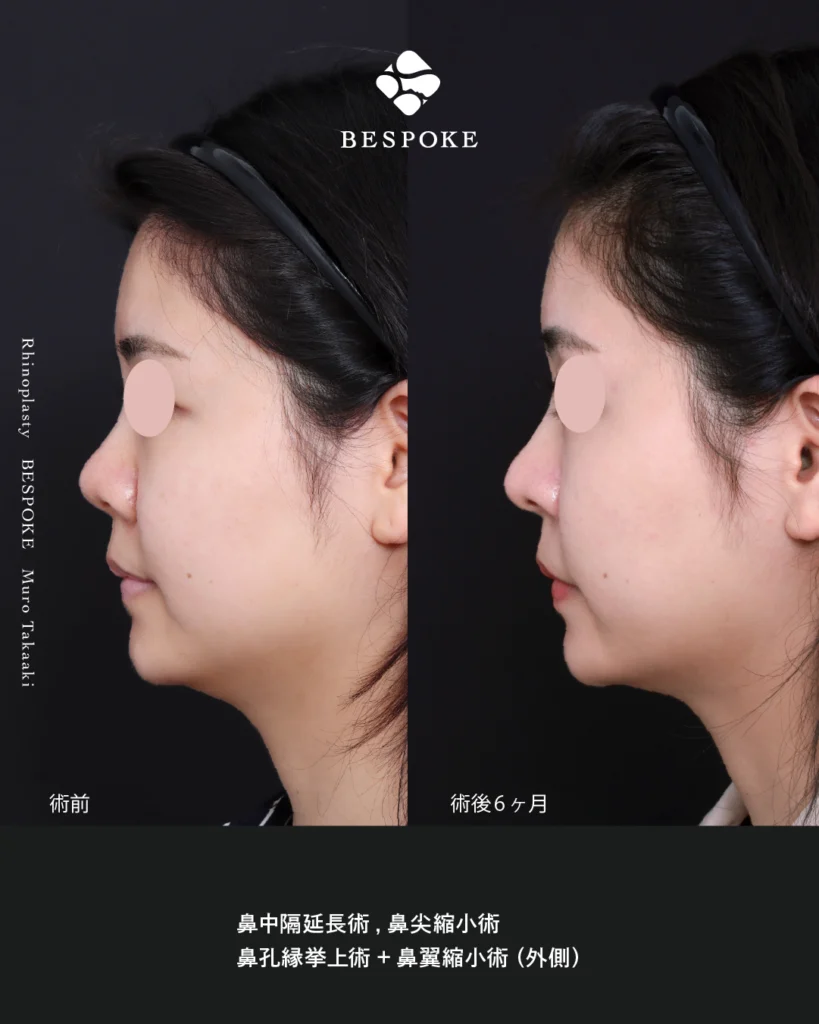 鼻中隔延長術、鼻尖縮小術、小鼻縮小術、鼻翼挙上術の症例