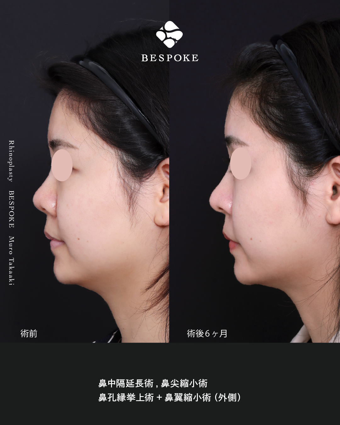 鼻中隔延長術、鼻尖縮小術、小鼻縮小術、鼻翼挙上術の症例
