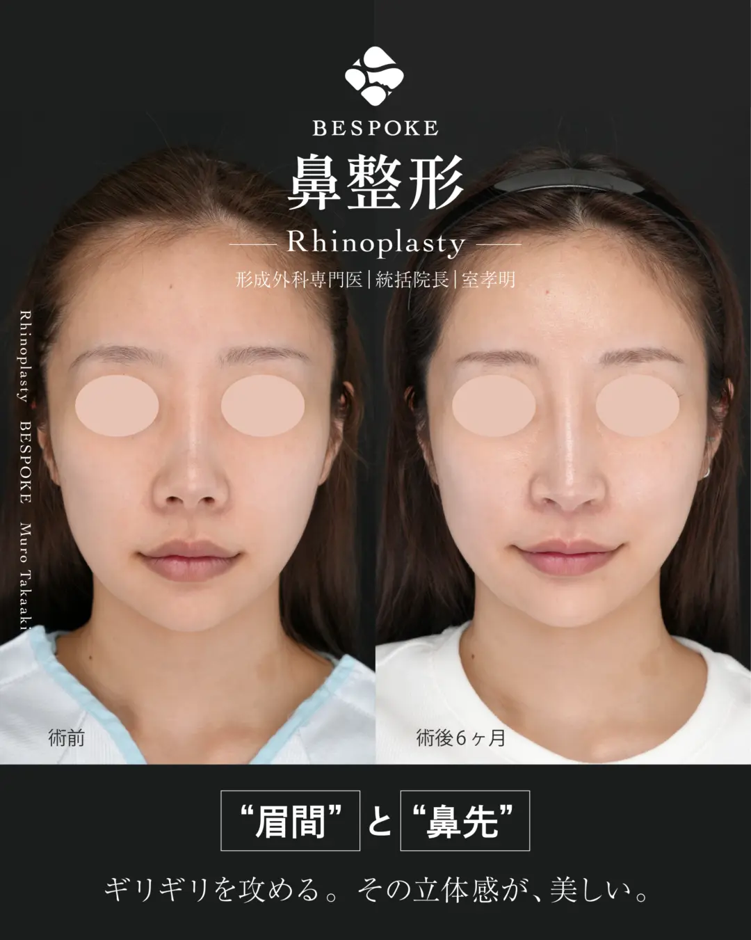 隆鼻術、鼻中隔延長術、鼻尖縮小術、小鼻縮小術、鼻孔縁挙上術の他院修正の症例