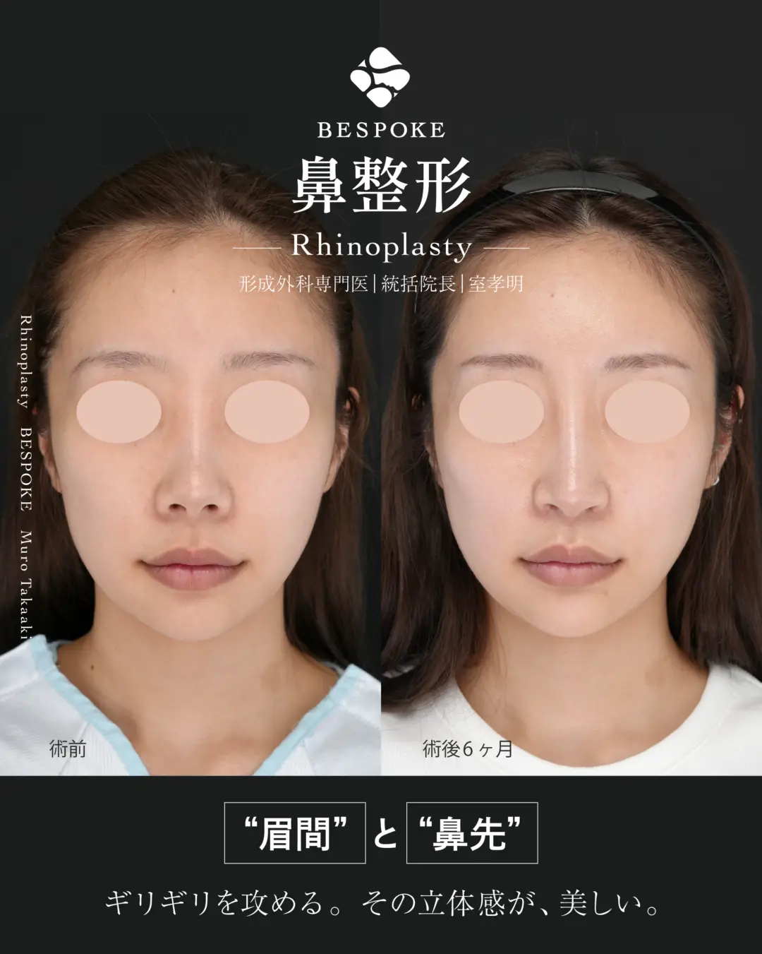 隆鼻術、鼻中隔延長術、鼻尖縮小術、小鼻縮小術、鼻孔縁挙上術の他院修正の症例