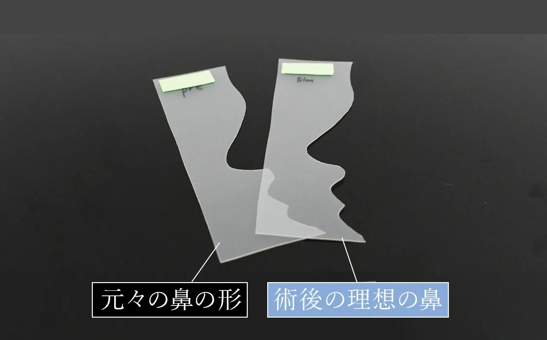 テンプレートサージャリー