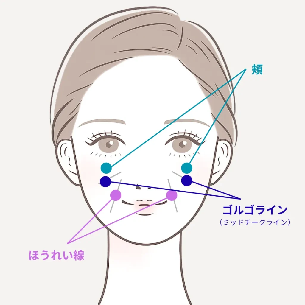 ヒアルロン酸注入おすすめ部位_40代