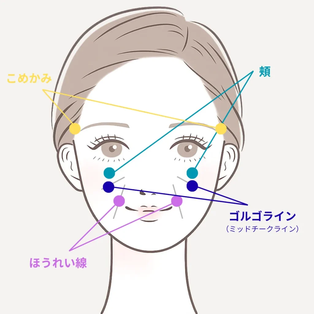 ヒアルロン酸注入おすすめ部位_50代