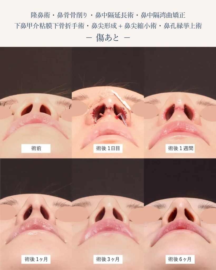 鼻孔縁挙上術の傷跡