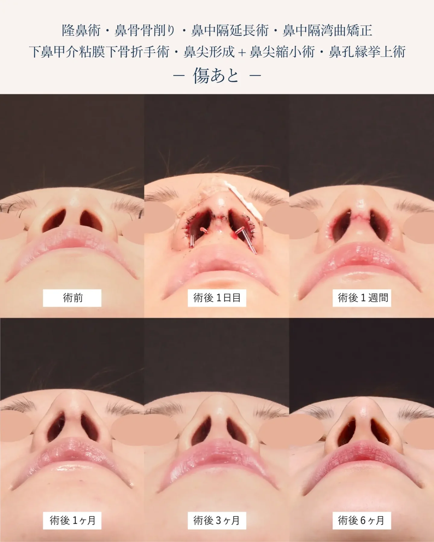 鼻孔縁挙上術の傷跡