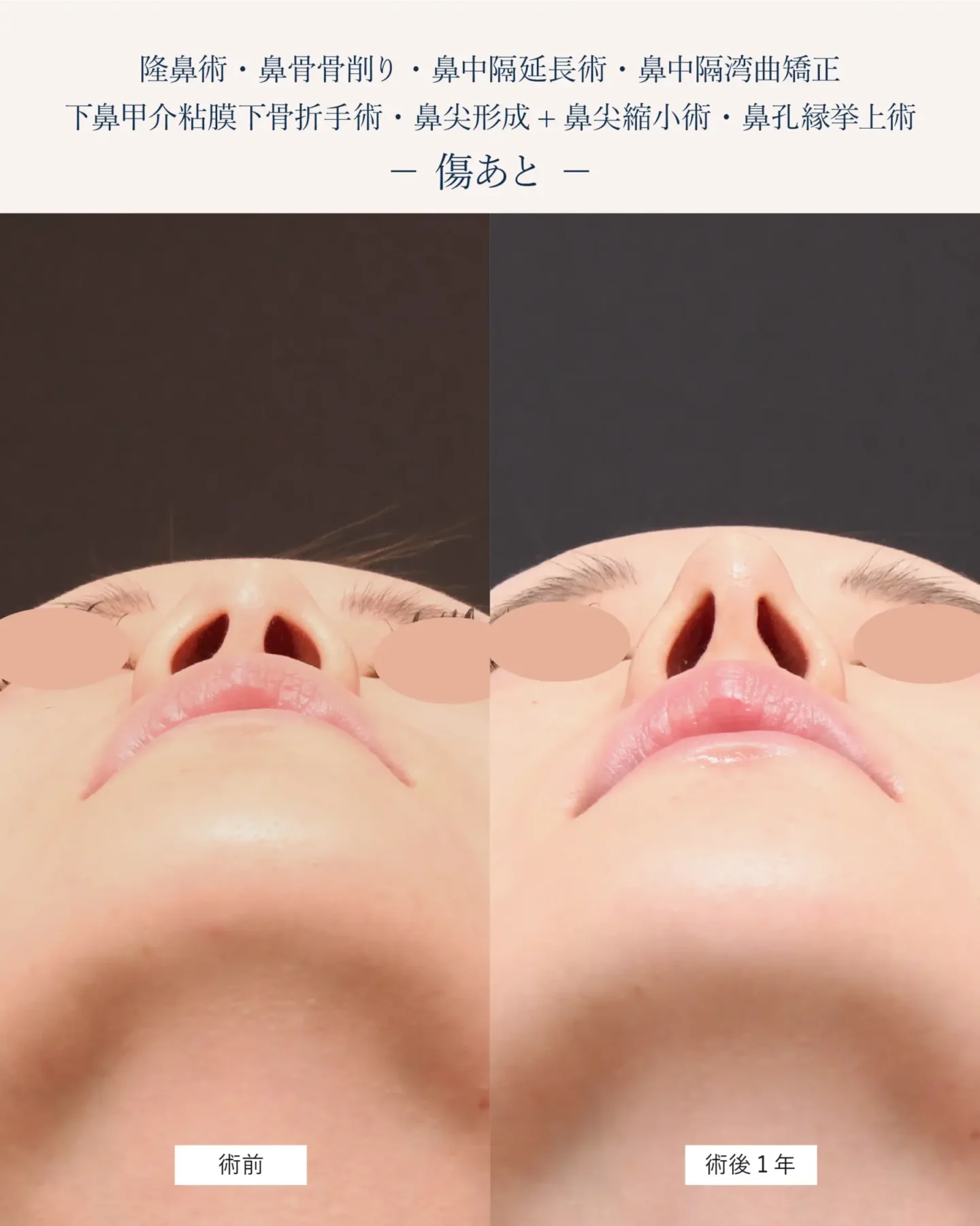 鼻孔縁挙上術の傷跡