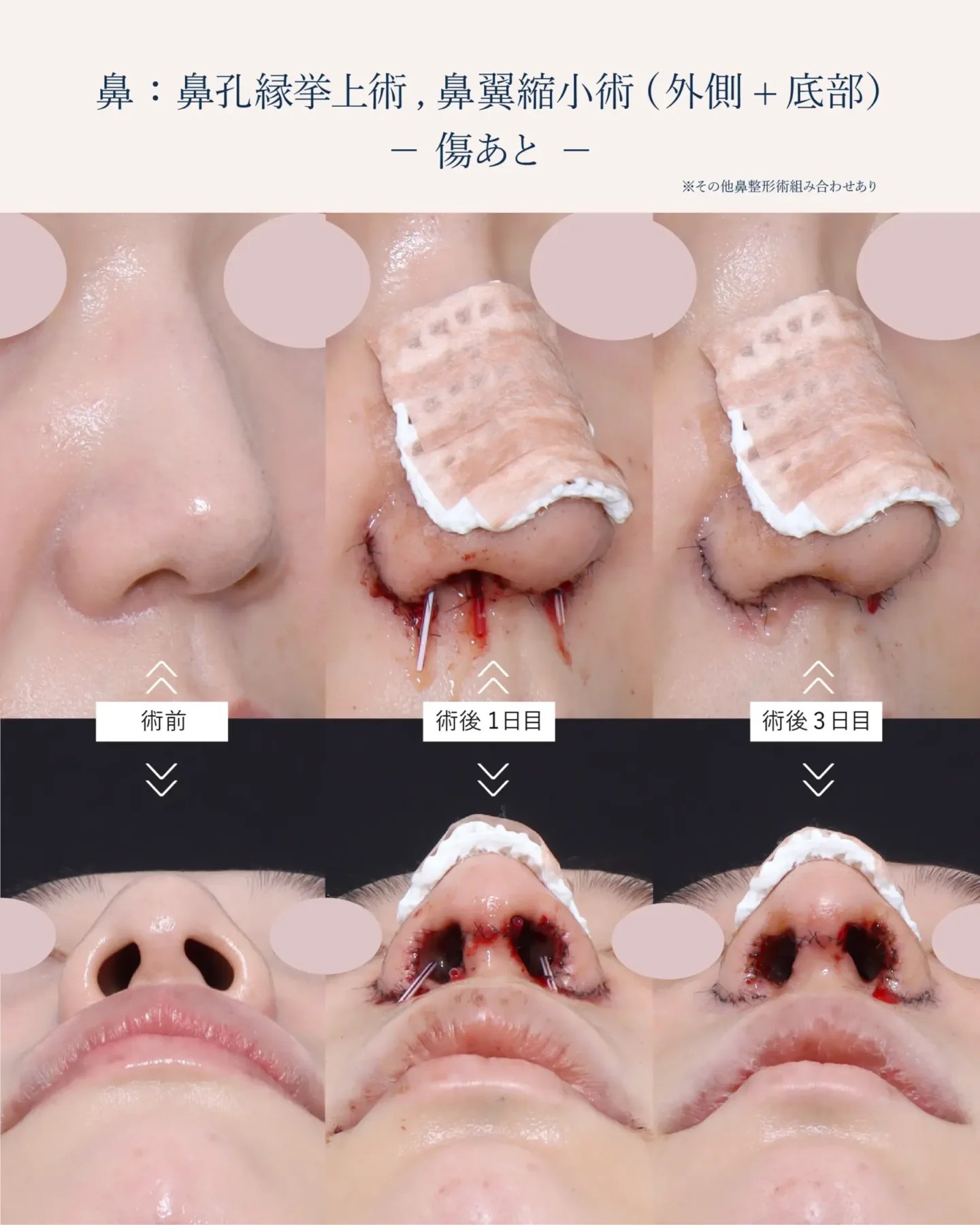 鼻孔縁挙上術の傷跡