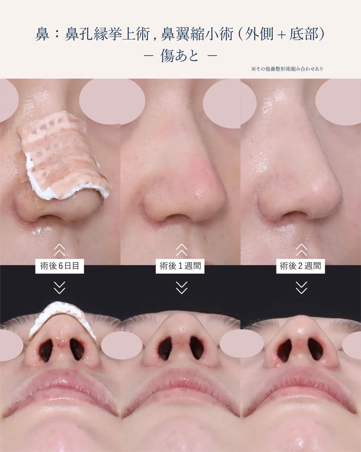 鼻孔縁挙上術の傷跡